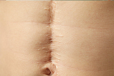 Istanbul-Scar Revision Istanbul-Scar revision